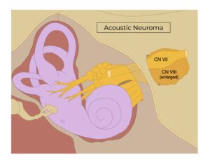 acoustic neuroma